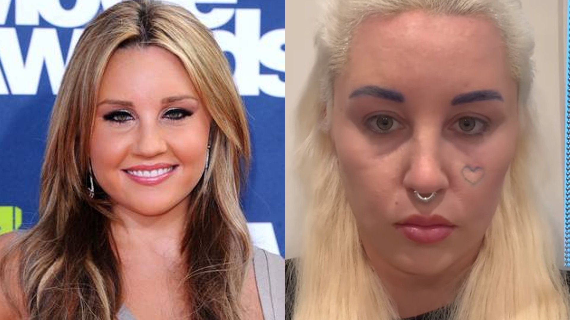 Amanda Bynes prima e dopo la blefaroplastica